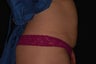 CoolSculpting Treatment of Abdomen