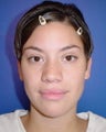 Septorhinoplasty