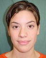 Septorhinoplasty