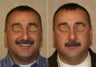male rhinoplasty