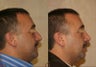 male rhinoplasty