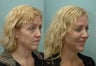 Facial Reconstructive Surgery