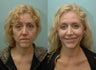 Facial Reconstructive Surgery
