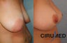 Breast uplift (mastopexy) and fat transfer