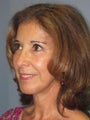 Chin Surgery on 62-year-old