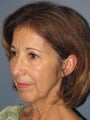 Chin Surgery on 62-year-old