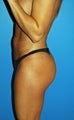 Brazilian Butt Lift