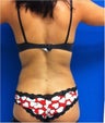 Laser Liposuction