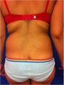 Laser Liposuction