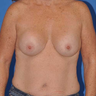 Breast Revision