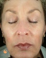Female Treated with BOTOX® Cosmetic and Restylane®