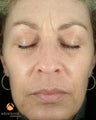 Female Treated with BOTOX® Cosmetic and Restylane®