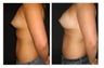 Breast Implants