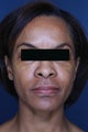 Fillers and Botox