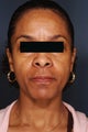 Fillers and Botox