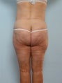 Body Lift