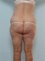 Body Lift