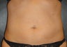 SmartLipo MPX