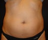 SmartLipo MPX