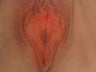 Vaginal Rejuvenation & Labiaplasty