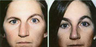 Female Treated for Unilateral Right Brow Ptosis