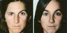 Female Treated for Unilateral Right Brow Ptosis