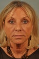 Remale Blepharoplasty