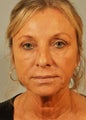 Remale Blepharoplasty