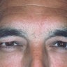 Botox