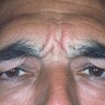 Botox