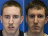 Combined rhinoplasty and chin implant