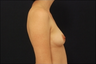 Breast Augmentation