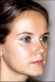 Rhinoplasty for a large tip