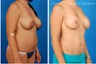 Breast lift with nipple reduction & liposuction