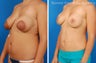 Breast lift with nipple reduction & liposuction