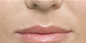 Juvederm