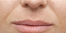 Juvederm