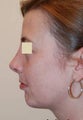 Rhinoplasty and Chin Implant, profile view