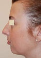 Rhinoplasty and Chin Implant, profile view