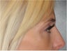 Non Surgical Nose Contouring