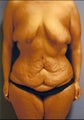 body lift