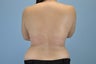 21 Year Old treated with VASER Shape