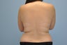 21 Year Old treated with VASER Shape