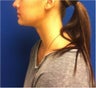 Laser Liposuction