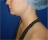 Laser Liposuction