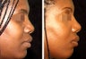 Young Female whom had Rhinoplasty