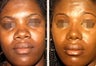 Young Female whom had Rhinoplasty