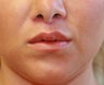 Lip Lift San Diego (permanent lip enhancement)
