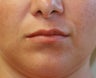 Lip Lift San Diego (permanent lip enhancement)