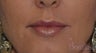 49 y/o female desired fuller lips with filler.